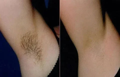 【LAST DAY SALE】HairAway™ - Rapid Hair Removal Spray