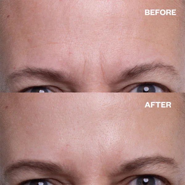 【LAST DAY SALE】AgeDefy™ - Anti-Wrinkle Face Patches