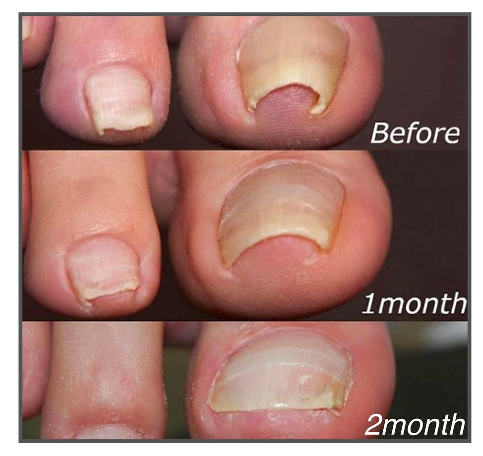 【LAST DAY SALE】Easy Patches™ - Correction Patches For Beautiful And Healthy Nails