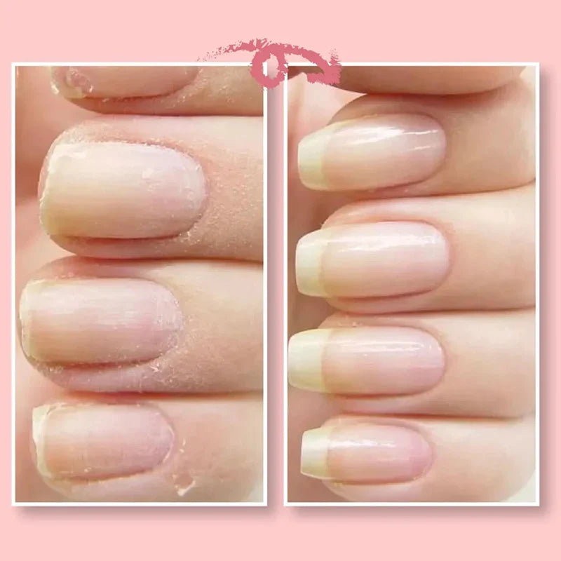 【LAST DAY SALE】NailShield™ - Nail Repair Protection Gel