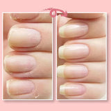 【LAST DAY SALE】NailShield™ - Nail Repair Protection Gel