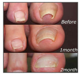 【LAST DAY SALE】Easy Patches™ - Correction Patches For Beautiful And Healthy Nails