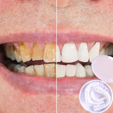 【LAST DAY SALE】Snap-on teeth™ - Always the perfect smile with these veneers